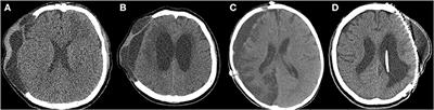 Predictive Factors of Surgical Site Infection Following <mark class="highlighted">Cranioplasty</mark>: A Study Including 3D Printed Implants